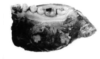 BONE, mandible
